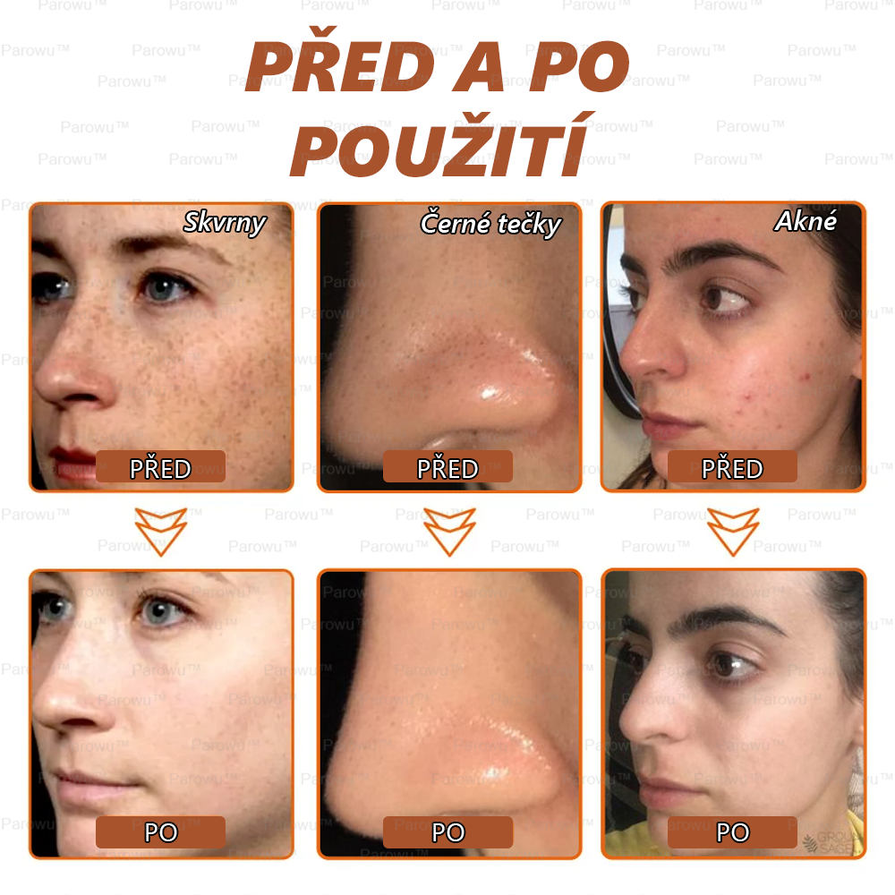 💟 Parowu™ Bělící a Odstraňující Skvrny Maska -🍀Přírodní složky trvale odstraňují pigmentové skvrny, stařecké skvrny, pihy a sluneční skvrny.