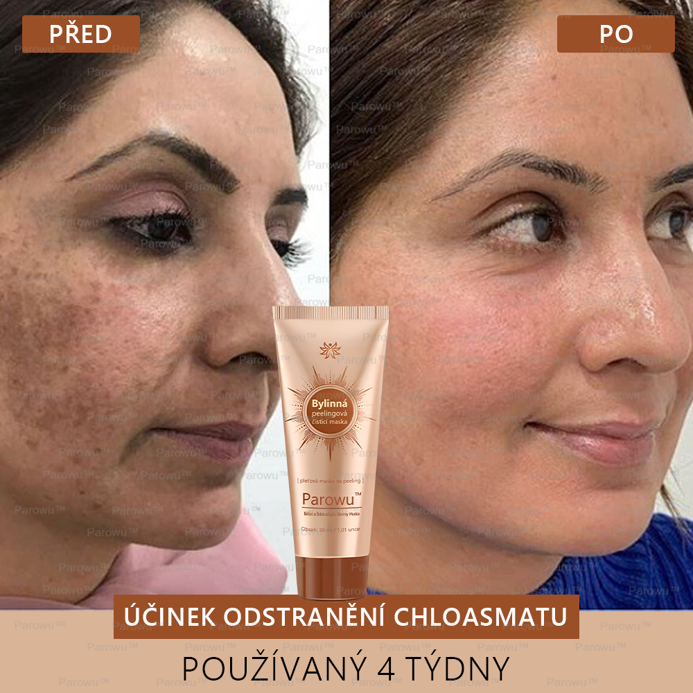 💟 Parowu™ Bělící a Odstraňující Skvrny Maska -🍀Přírodní složky trvale odstraňují pigmentové skvrny, stařecké skvrny, pihy a sluneční skvrny.