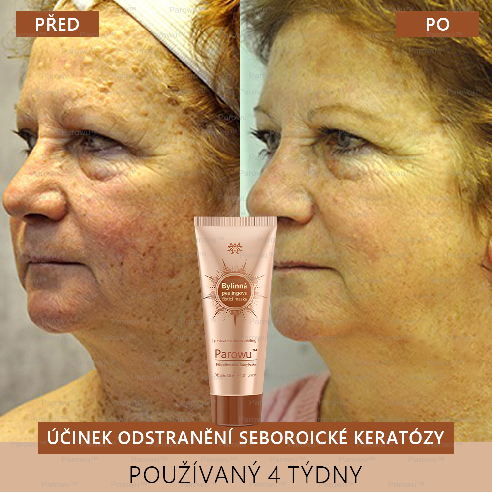 💟 Parowu™ Bělící a Odstraňující Skvrny Maska -🍀Přírodní složky trvale odstraňují pigmentové skvrny, stařecké skvrny, pihy a sluneční skvrny.