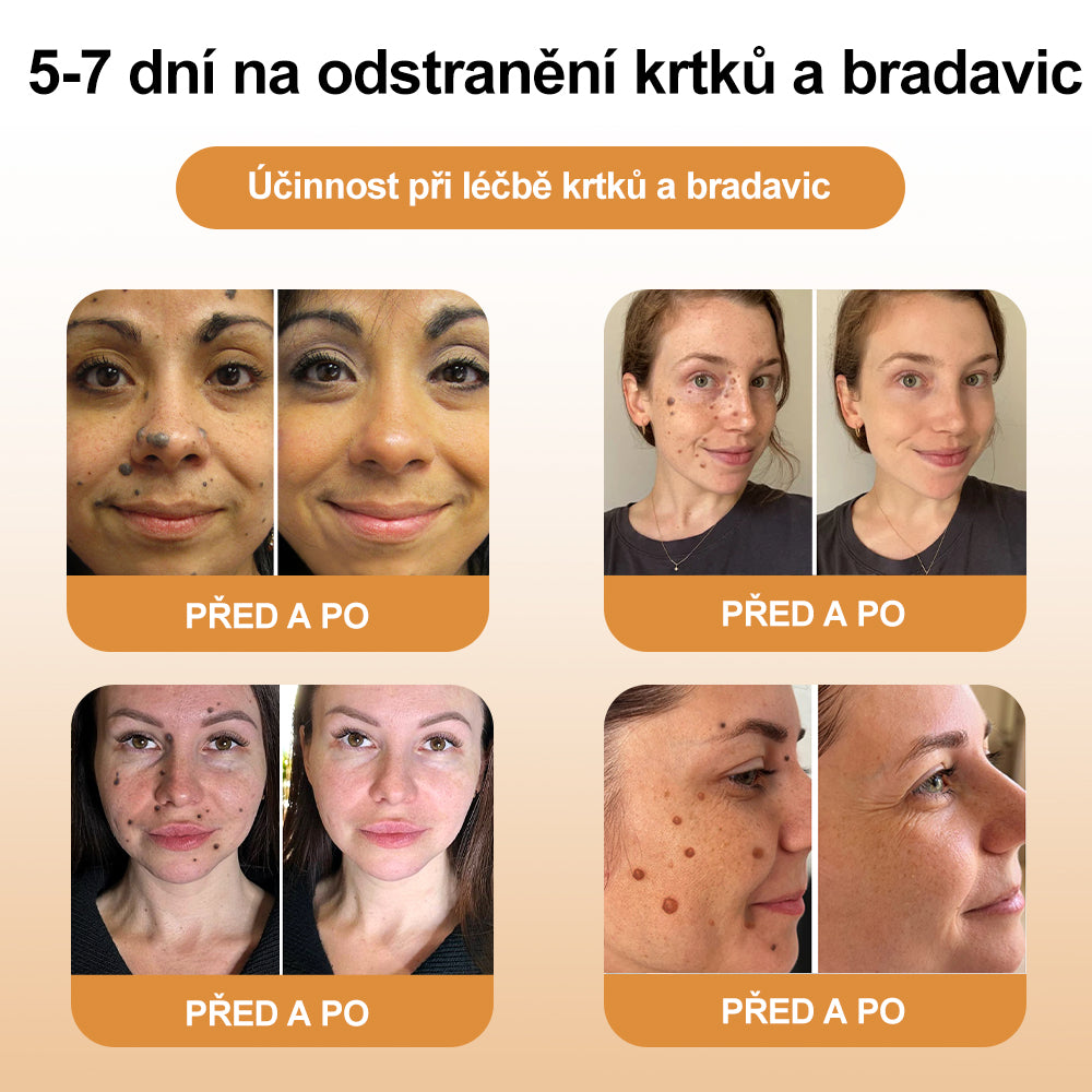 🌿🌿[✨Oficiální značkový obchod✨] XRLXRL™ Včela Jed Krém na Odstranění Bradavic a Znamének (👨‍⚕️ČDS DOPORUČUJE)