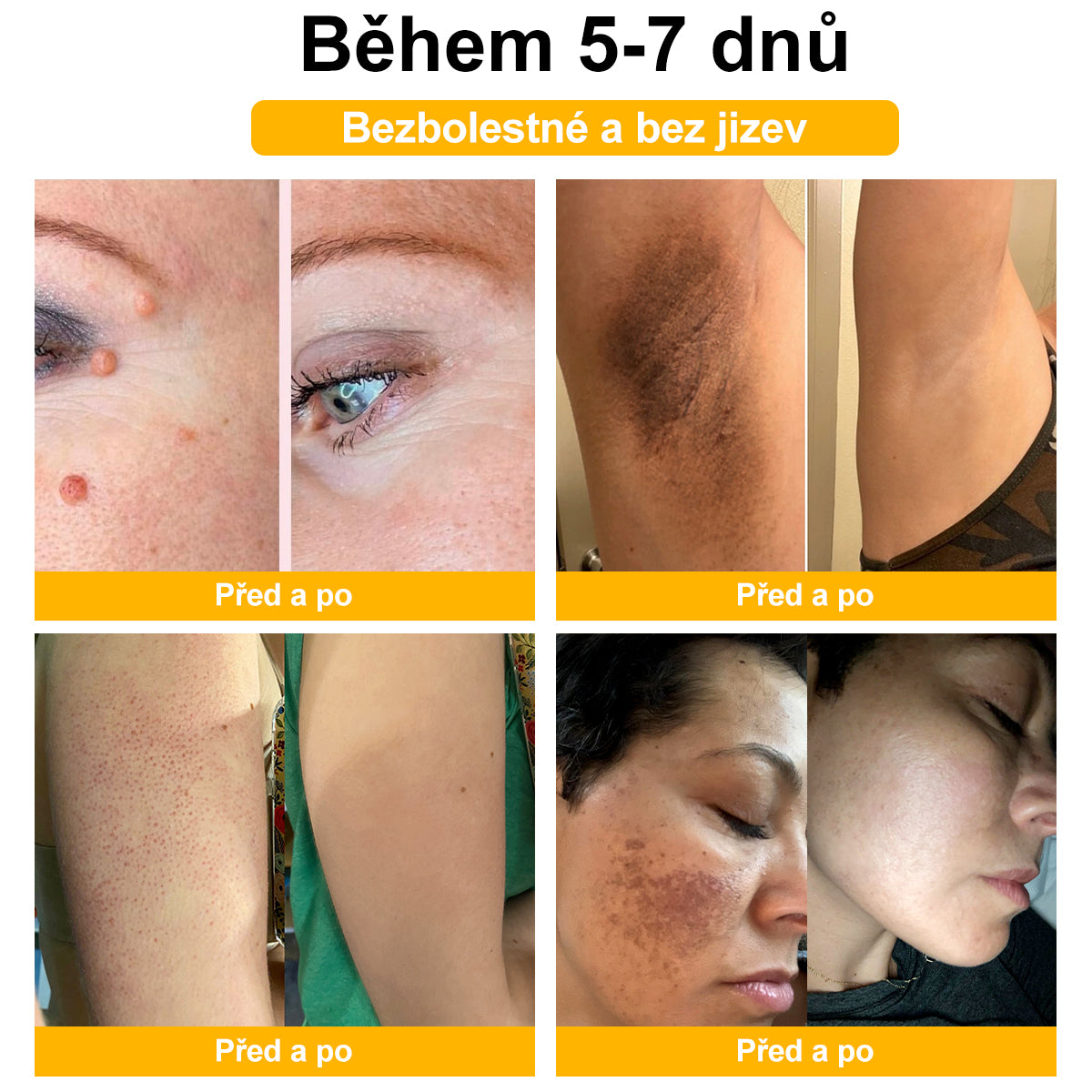 💎💎💎[✨Oficiální značkový obchod✨] DermaČist™ Včelí jed Krém na ošetření krtků a bradavic (👨‍⚕️ČDS DOPORUČUJE)