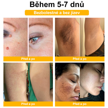 💎💎💎[✨Oficiální značkový obchod✨] DermaČist™ Včelí jed Krém na ošetření krtků a bradavic (👨‍⚕️ČDS DOPORUČUJE)