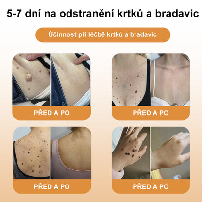 💎💎💎[✨Oficiální značkový obchod✨] DermaČist™ Včelí jed Krém na ošetření krtků a bradavic (👨‍⚕️ČDS DOPORUČUJE)