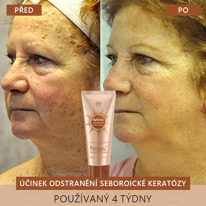 💟💟 Parowu™ Bělící a Odstraňující Skvrny Maska -🍀Přírodní složky trvale odstraňují pigmentové skvrny, stařecké skvrny, pihy a sluneční skvrny